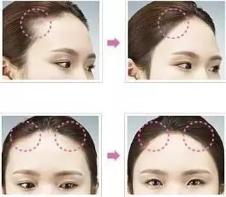 拯救发际线扁塌头发,拯救发际线告别大额头