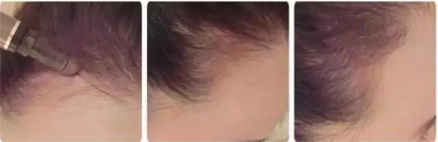 拯救发际线扁塌头发,拯救发际线告别大额头