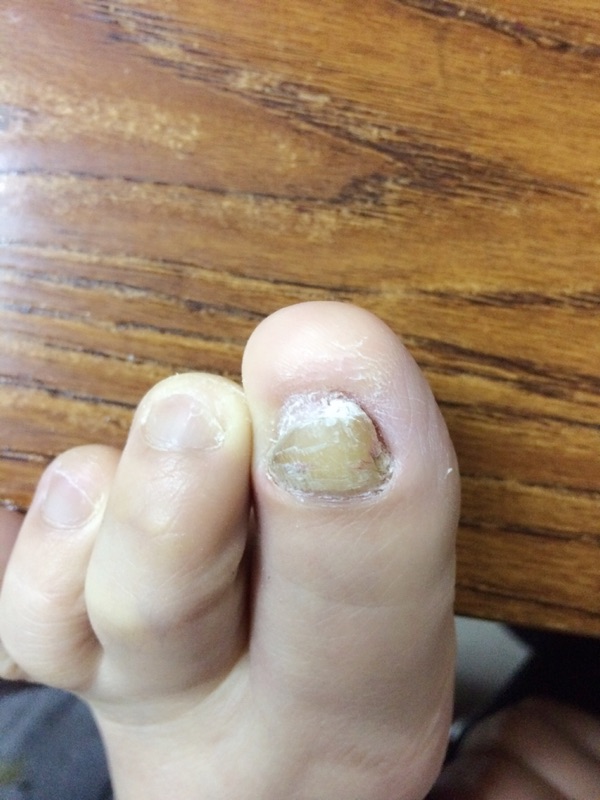有灰指甲有什么影响吗,有灰指甲是不是会脚趾头痛
