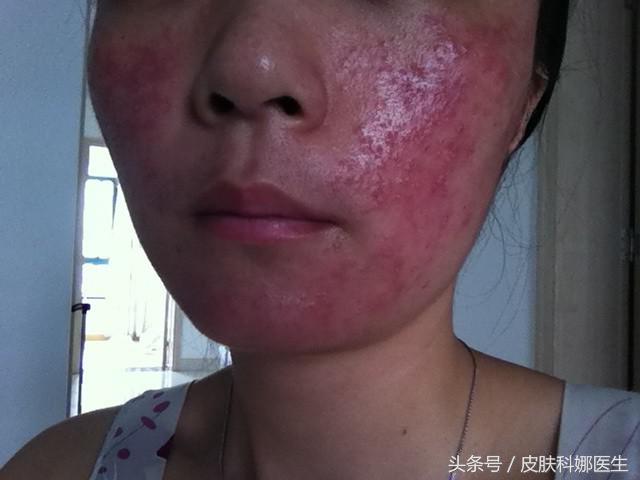 激素依赖性皮炎涂抹什么药,激素依赖性皮炎怎么治疗好得快