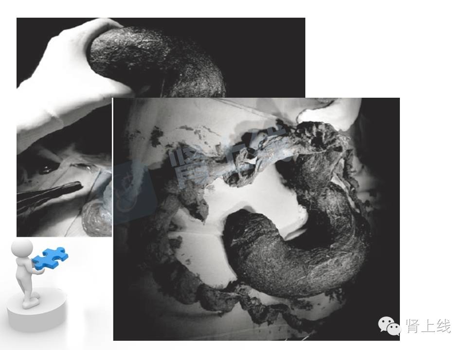 吃山楂取出胃结石,吃10个山楂胃结石有多少