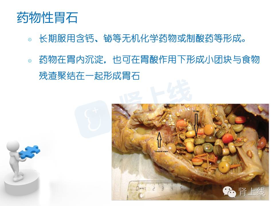 吃山楂取出胃结石,吃10个山楂胃结石有多少