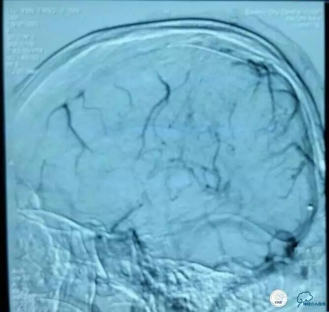 下肢血栓微创介入治疗的费用,急性深静脉血栓形成的诊断和治疗
