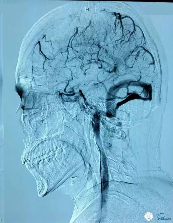 下肢血栓微创介入治疗的费用,急性深静脉血栓形成的诊断和治疗