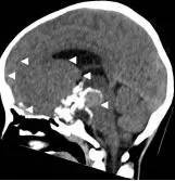 周忠清颅咽管瘤全切的终身复发率,周忠清谈颅咽管瘤术后寿命