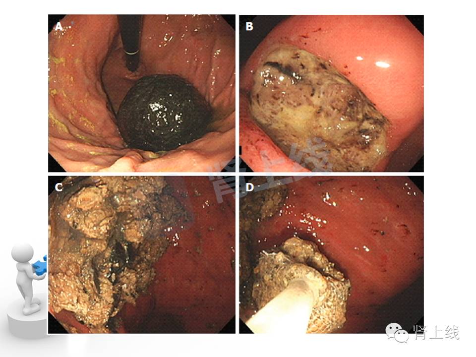 吃山楂取出胃结石,吃10个山楂胃结石有多少