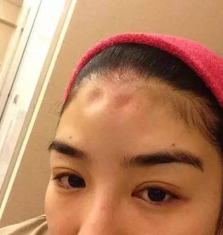 一级脑震荡严重吗,严重脑震荡后遗症症状