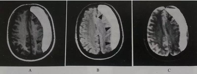 一级脑震荡严重吗,严重脑震荡后遗症症状