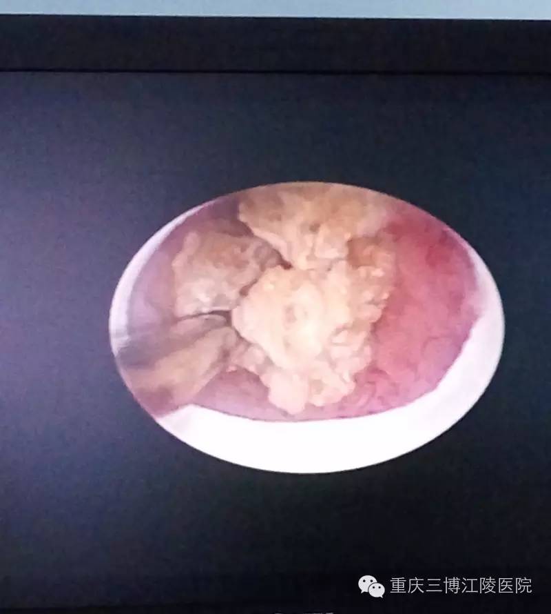 深圳哪个医院治疗结石最好,深圳治疗结石的方法