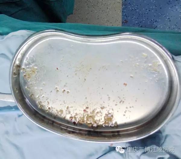 深圳哪个医院治疗结石最好,深圳治疗结石的方法