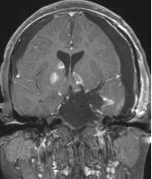 周忠清颅咽管瘤全切的终身复发率,周忠清谈颅咽管瘤术后寿命