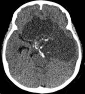 周忠清颅咽管瘤全切的终身复发率,周忠清谈颅咽管瘤术后寿命