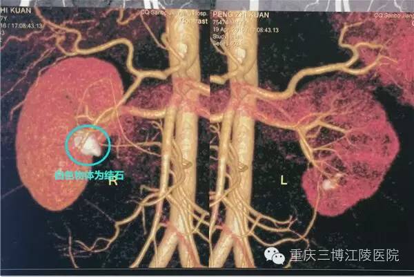 深圳哪个医院治疗结石最好,深圳治疗结石的方法