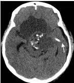 周忠清颅咽管瘤全切的终身复发率,周忠清谈颅咽管瘤术后寿命