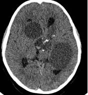 周忠清颅咽管瘤全切的终身复发率,周忠清谈颅咽管瘤术后寿命