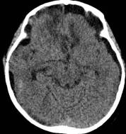 周忠清颅咽管瘤全切的终身复发率,周忠清谈颅咽管瘤术后寿命