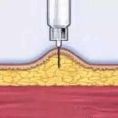 胰岛素注射笔针头选择,胰岛素针头执行标准