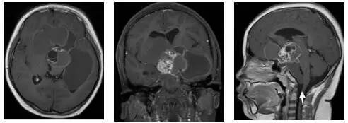 周忠清颅咽管瘤全切的终身复发率,周忠清谈颅咽管瘤术后寿命