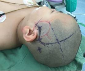 周忠清颅咽管瘤全切的终身复发率,周忠清谈颅咽管瘤术后寿命