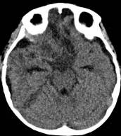 周忠清颅咽管瘤全切的终身复发率,周忠清谈颅咽管瘤术后寿命