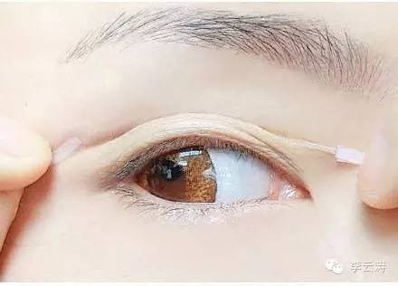 双眼皮18天消肿方法,贴双眼皮教程三眼皮