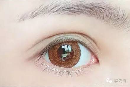 双眼皮18天消肿方法,贴双眼皮教程三眼皮