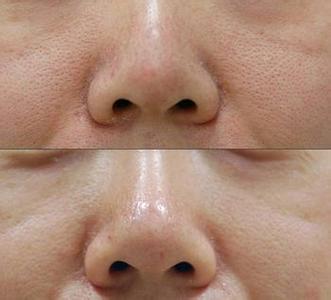 宝宝毛孔粗大是怎么回事,什么导致小孩毛孔粗大