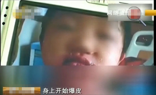 孩子玩泡泡液导致脸红,宝宝玩泡泡水脸上红肿