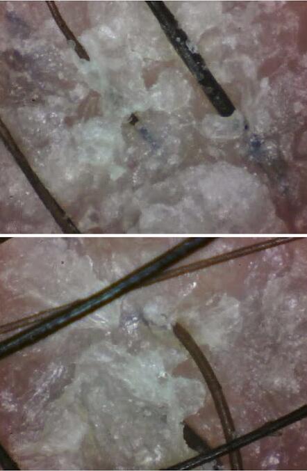 额头头皮屑多怎么回事,男士头皮屑多怎么回事