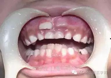 小孩的牙齿怎么会长两层,小孩怎么才能长出好看牙齿