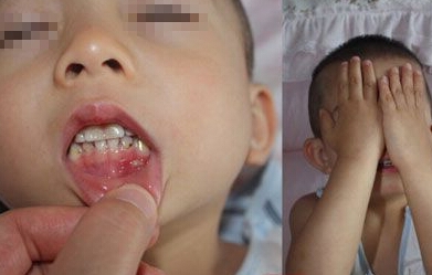 儿童疱疹病毒怎么治疗根除,如何预防儿童单纯疱疹