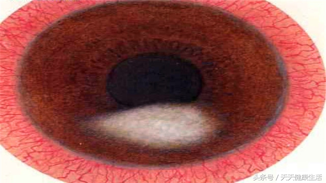 女孩眼睛角膜溃疡,小朋友眼角膜红是什么原因怎么办