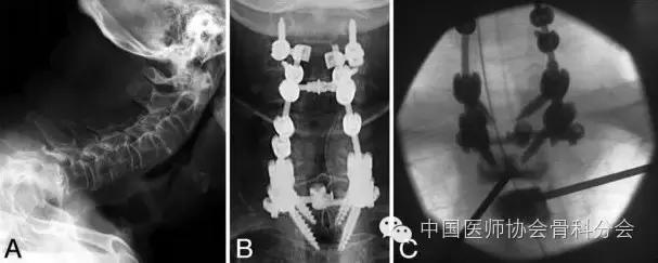 骨科经典案例分享,骨科微创实例