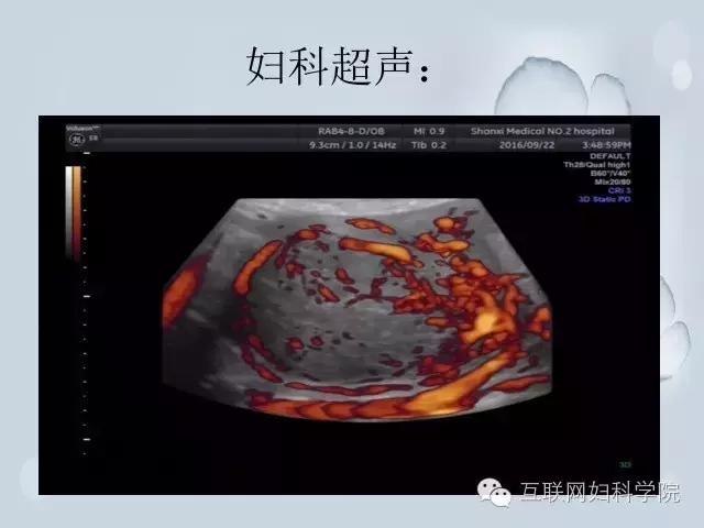 郝敏教授手术直播上线，两台妇科腹腔镜手术!（含视频）