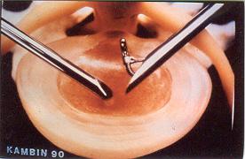 微创手术治疗腰椎间盘突出成功率,目前最热门腰椎微创技术椎间孔镜