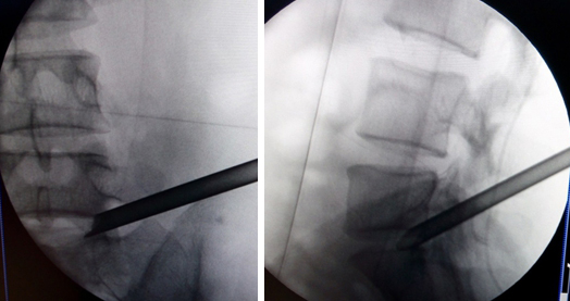 微创手术治疗腰椎间盘突出成功率,目前最热门腰椎微创技术椎间孔镜