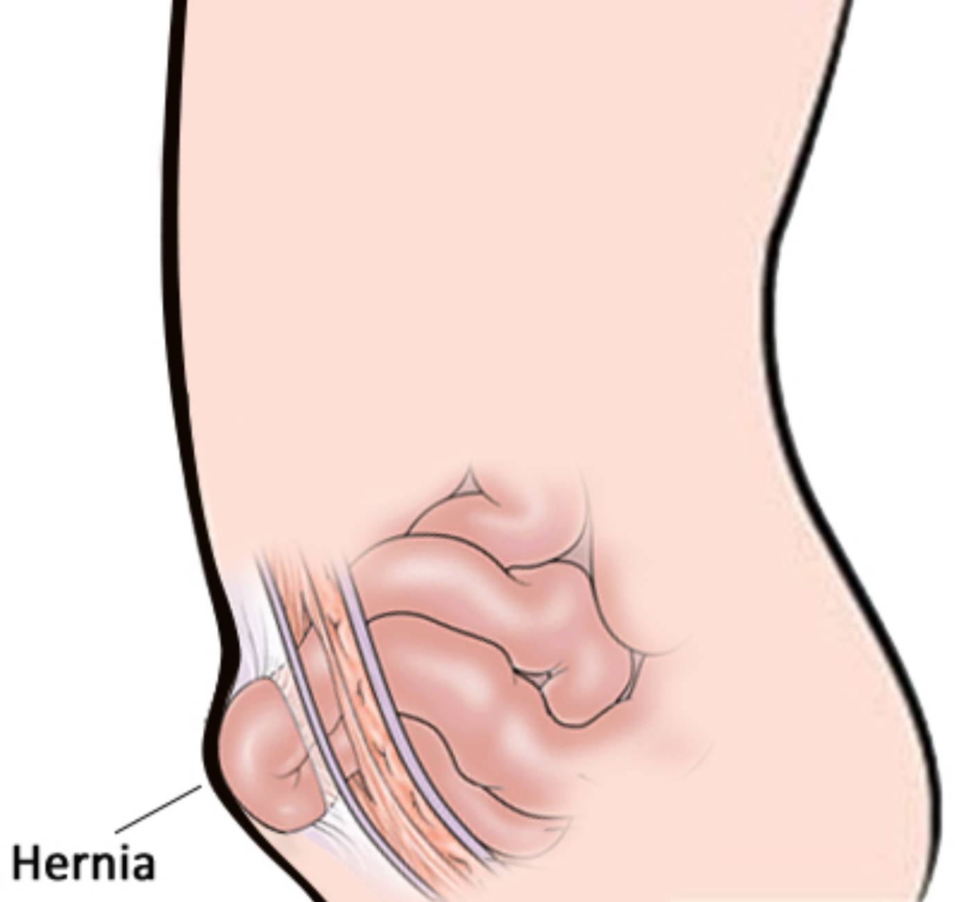 疝气不是很严重还需手术吗,疝气属不属于慢性病