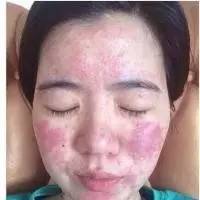 杨紫自爆过敏严重似毁容,难道她的护肤品是假货?