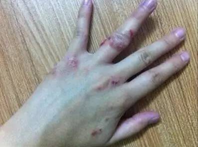 湿疹护理问题及护理措施大全,孕期如何预防宝宝湿疹