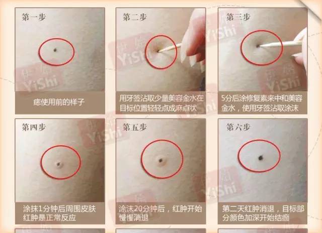 痣该不该祛,有痣需要去掉吗