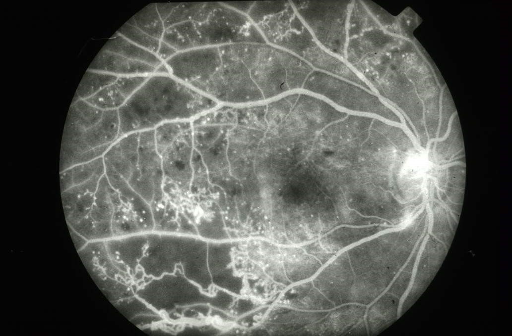 关注糖尿病症状改善,关于糖尿病视网膜的筛查宣传报道