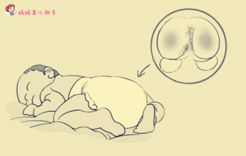 小屁屁起红疹上有小白点,宝宝小屁屁起红疹能用皮白金吗