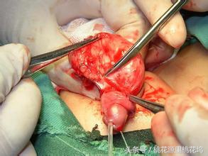 如果长了脂肪瘤怎么办？憋激动，淡然除之