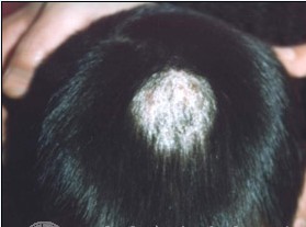 头皮癣会引起掉发吗,头皮癣是怎么引起的