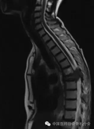 骨科经典案例分享,骨科微创实例