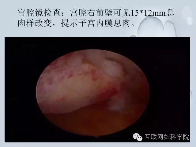 郝敏教授手术直播上线，两台妇科腹腔镜手术!（含视频）