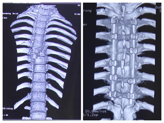 病例压迫神经康复视频,脊髓损伤康复分享