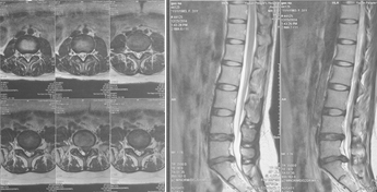 微创手术治疗腰椎间盘突出成功率,目前最热门腰椎微创技术椎间孔镜