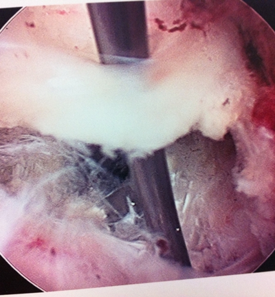 微创手术治疗腰椎间盘突出成功率,目前最热门腰椎微创技术椎间孔镜