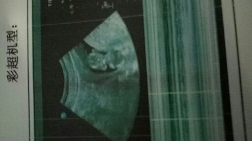 切完阑尾又切宫颈息肉,NT宝宝还是长得健健康康的